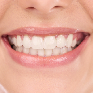 The Ultimate Guide to Teeth Whitening in Austintown