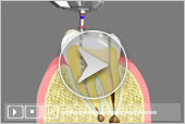3D Dental Patient Education - Root Canal Treatment in Liberty Township, Youngstown, Austintown, Girard, Hubbard, Niles, Hudson
